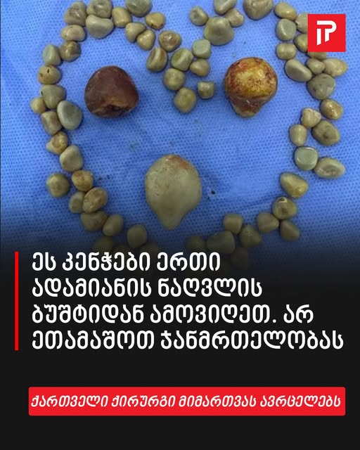 „ეს კენჭები ერთი ადამიანის ნაღვლის ბუშტიდან ამოვიღეთ. არ ეთამაშოთ ჯანმრთელობას” – ქართველი ქირურგი