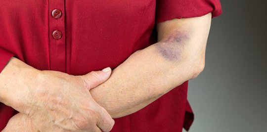 თქვენს სხეულზე ხშირად ჩნდება ასეთი ჩალურჯებები?-ამას თავის მიზეზი აქვს და ეს უნდა იცოდეთ!